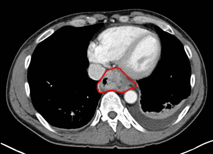 Cross-sectional CT and endoscopic ultrasound images demonstrating oesophageal wall thickening and locoregional lymph nodes used for staging.