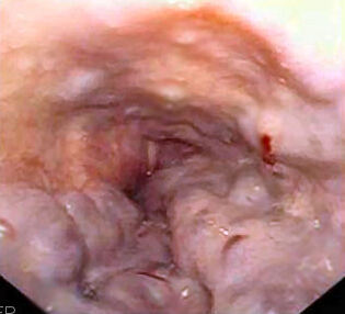 Endoscopic view of raised serpiginous oesophageal varices with prominent red wale markings, labelled as endoscopic features associated with increased bleeding risk.