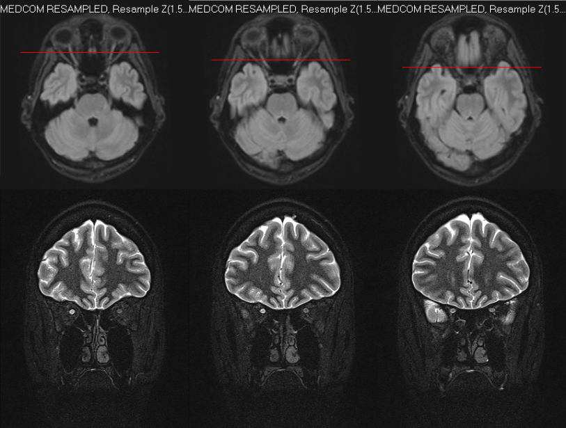 Multipanel orbital MRI showing asymmetric increased signal and enhancement of the right optic nerve in optic neuritis.