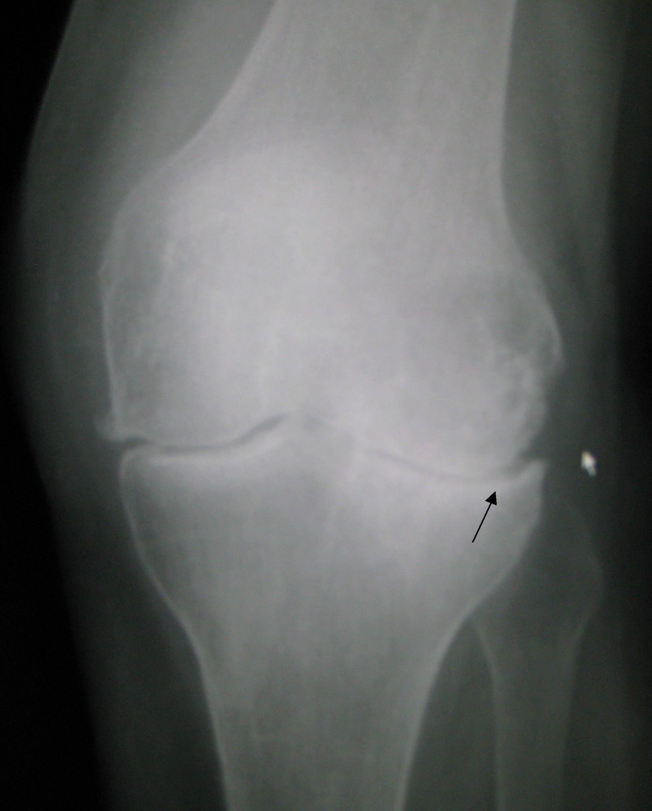 Radiograph of a joint showing joint-space narrowing, subchondral sclerosis and marginal osteophytes, the structural features commonly associated with osteoarthritis.