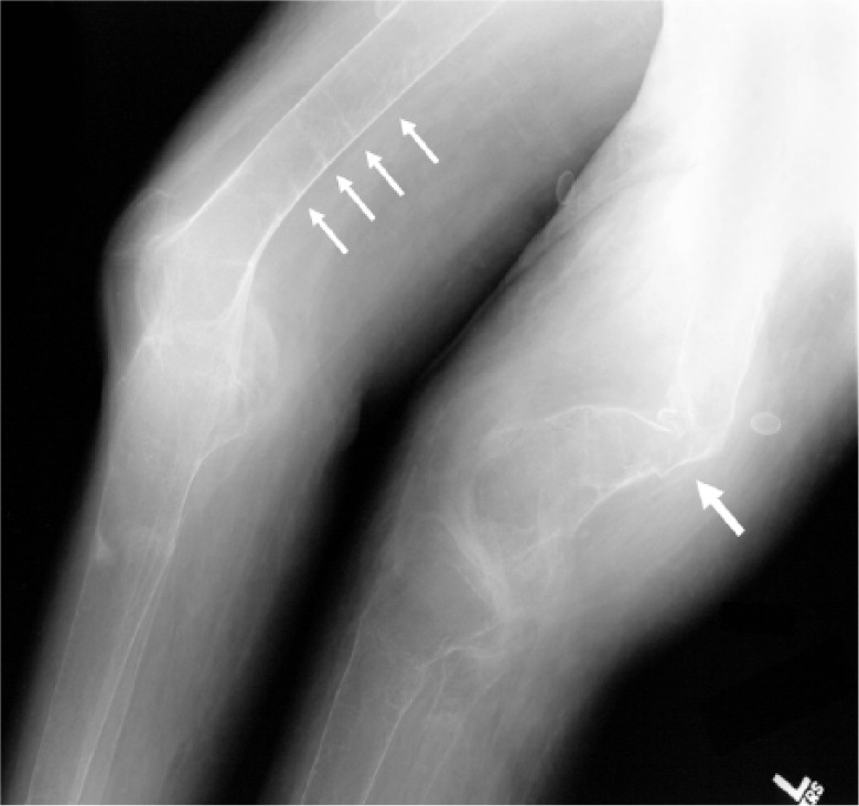 Radiographic example of severe osteomalacia with diffuse osteopenia and pathological or pseudofracture changes. The image should be checked for diagnostic legibility and teaching value in the separate image campaign.