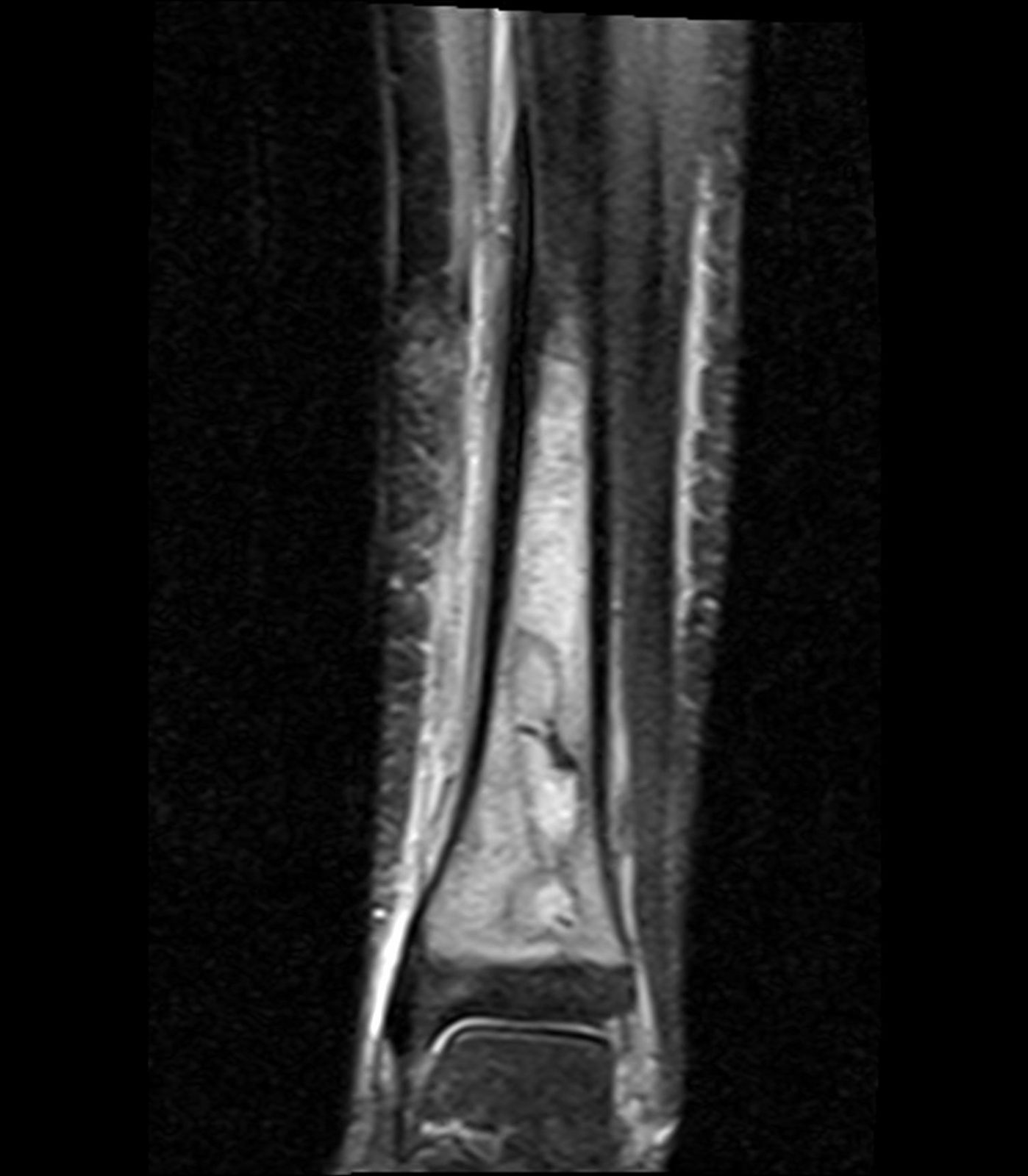 A coronal STIR MRI of the distal tibia showing a focal Brodie abscess with surrounding bone-marrow oedema in subacute osteomyelitis. Confirm that the lesion is legible and diagnostically teachable in the separate image campaign.