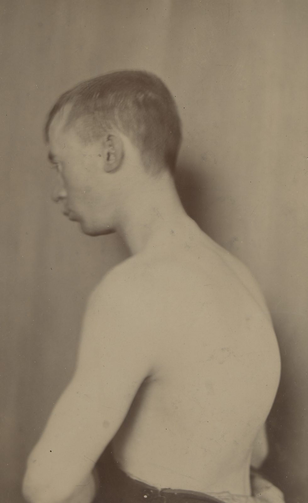 Clinical image illustrating thoracic kyphosis after vertebral fractures, with a note that height loss and kyphosis should prompt vertebral-fracture assessment.