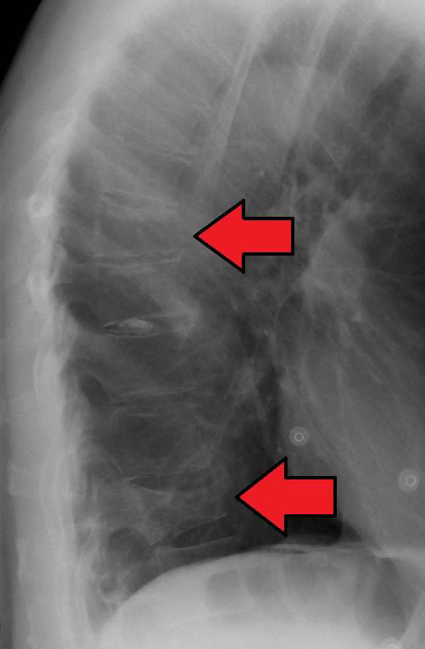 Lateral spine radiograph showing anterior wedging of a vertebral body due to an osteoporotic compression fracture.