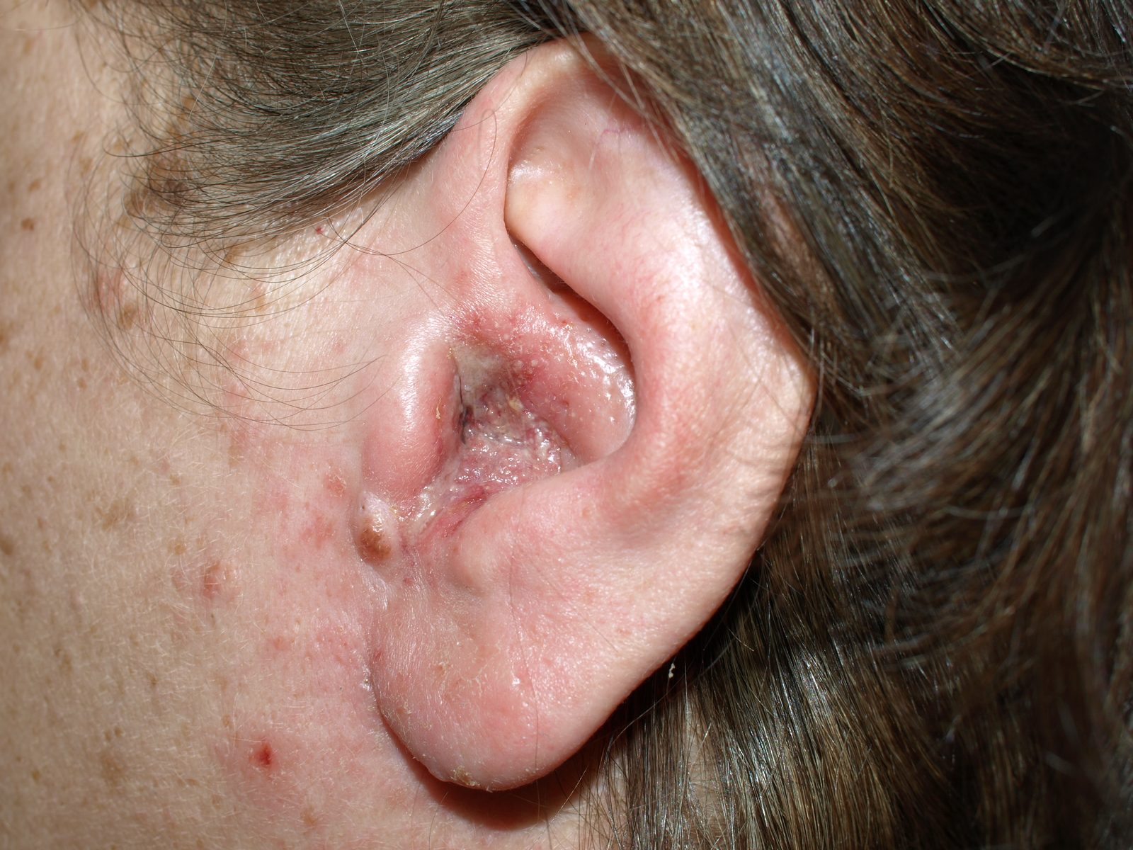 Clinical photograph of an inflamed external auditory meatus with purulent discharge and debris in otitis externa.