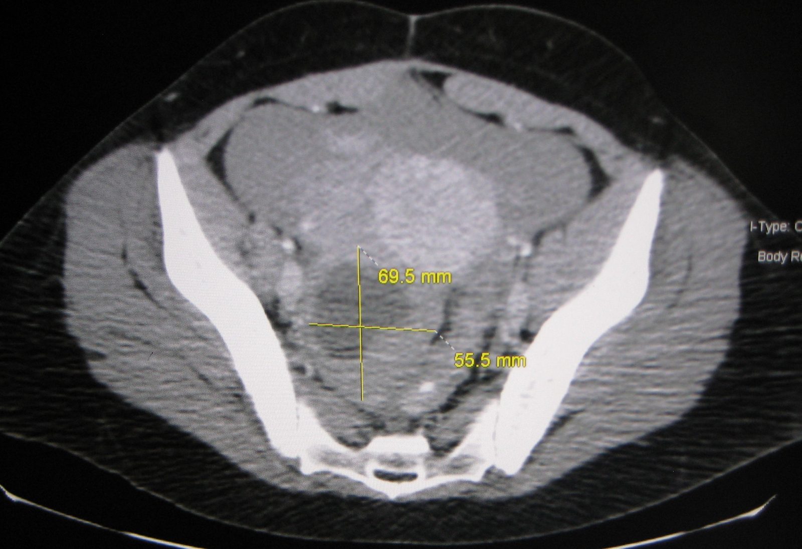 Axial pelvic CT showing a large heterogeneous right adnexal cystic lesion measuring approximately 7 by 5.5 cm, consistent with a haemorrhagic ovarian cyst.