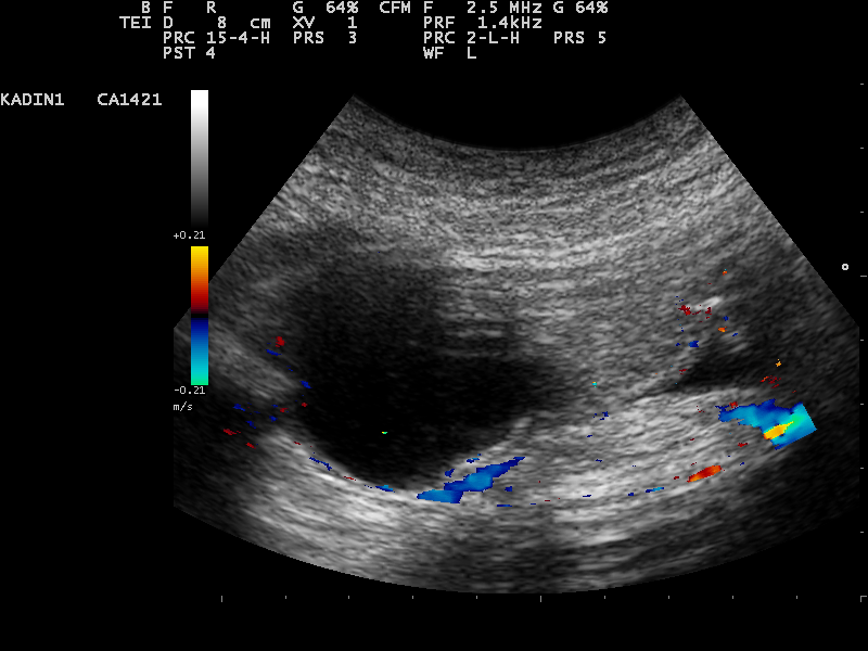 Example labelled ovarian torsion, with an enlarged cystic ovary and persisting peripheral colour signals. Preserved flow does not exclude torsion; interpret ultrasound alongside symptoms and urgent gynaecological assessment.