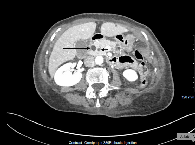 Axial contrast-enhanced CT showing dilatation of the common bile duct and pancreatic duct, with a clear annotation that the double-duct sign is a clue to obstruction rather than a diagnosis by itself.
