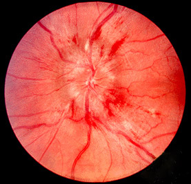 A fundus photograph of severe papilloedema showing optic-disc swelling with blurred margins, vascular congestion and peripapillary haemorrhage. Label it as a clinical example, not a standalone diagnosis.
