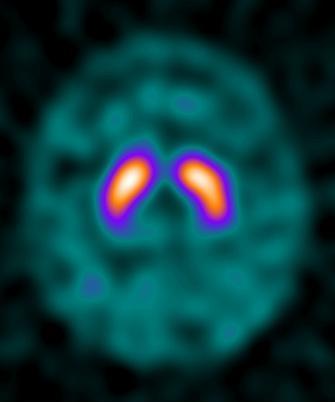Dopamine-transporter SPECT showing reduced putaminal uptake, producing a full-stop rather than the normal comma shape in the striatum.