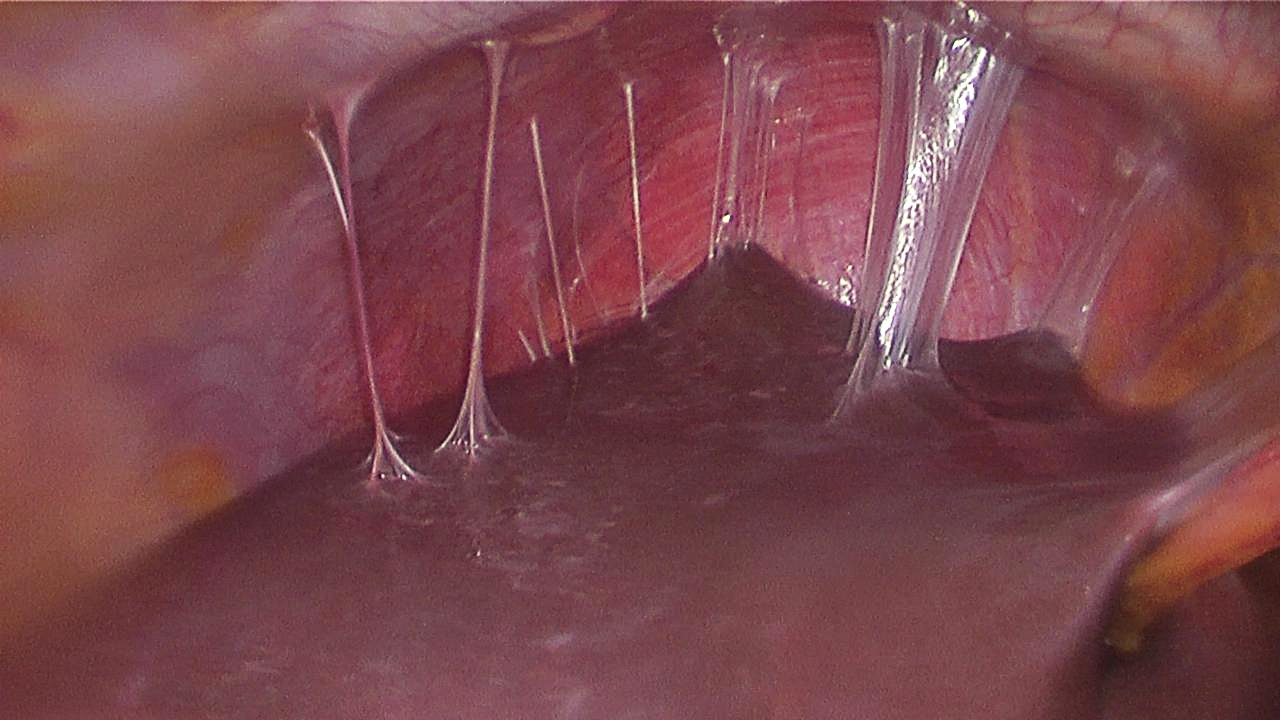 Laparoscopic image showing violin-string adhesions between the liver capsule and abdominal wall following pelvic infection.