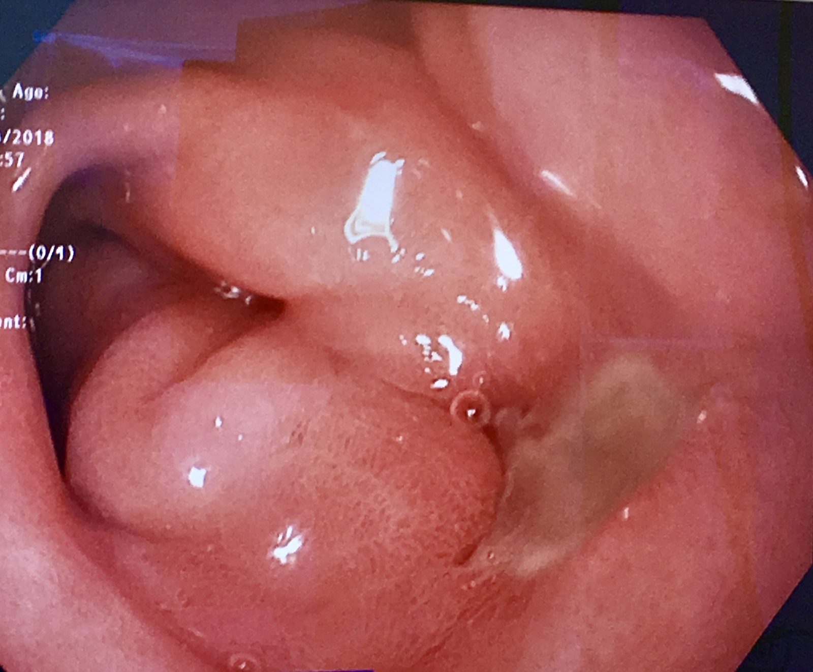 Endoscopic image of a gastric ulcer showing a discrete mucosal defect with a visible base; diagnosis and malignancy exclusion require endoscopic assessment and biopsy.