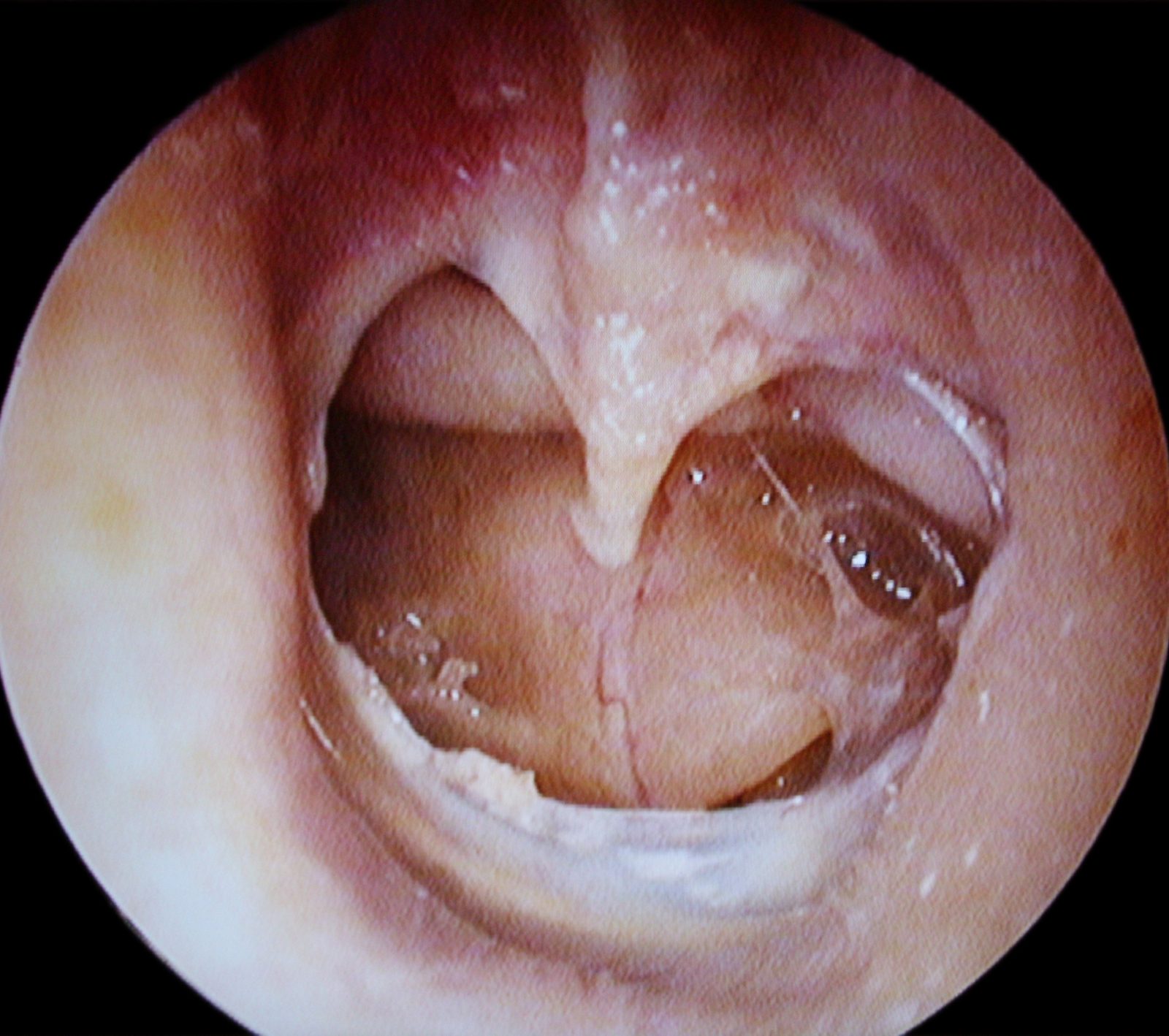 Otoscopy showing a large central tympanic-membrane perforation with middle-ear structures visible through the defect.