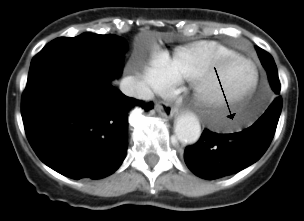 Axial contrast-enhanced CT showing a large circumferential pericardial effusion surrounding the heart, with labels distinguishing fluid from the myocardium and pleural space.
