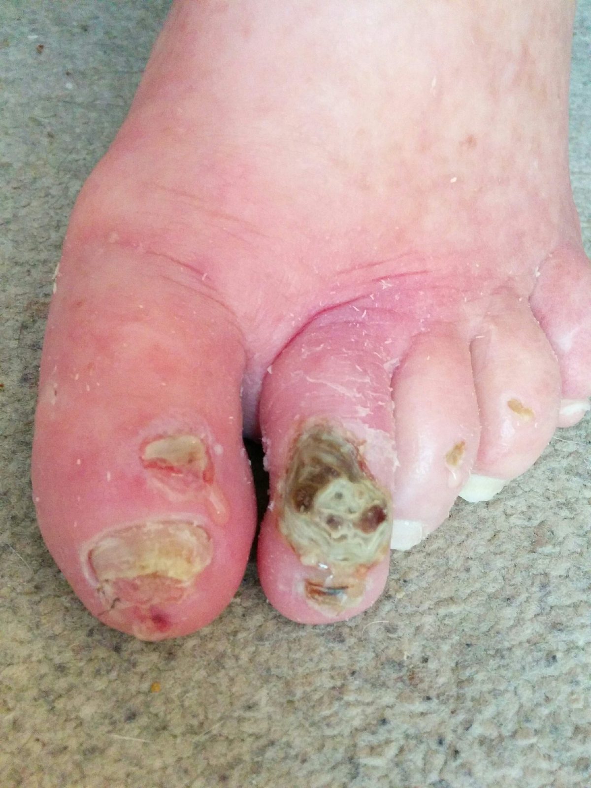 Clinical photograph of a distal arterial ulcer over a pressure point with a pale base, showing tissue loss that requires vascular assessment.