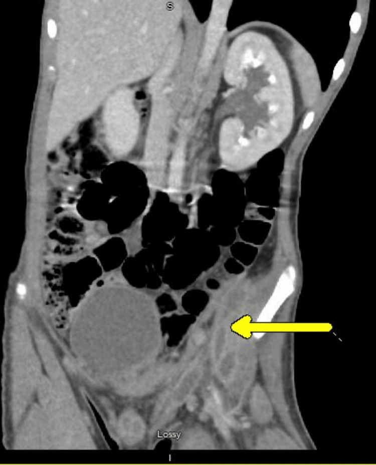 Coronal contrast-enhanced CT showing a pelvic fluid collection as a potential source of secondary peritonitis and a target for image-guided drainage.