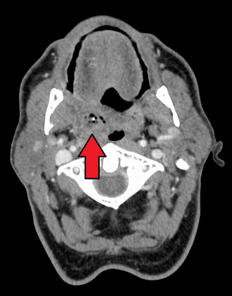 Axial CT of the neck showing a peritonsillar abscess.