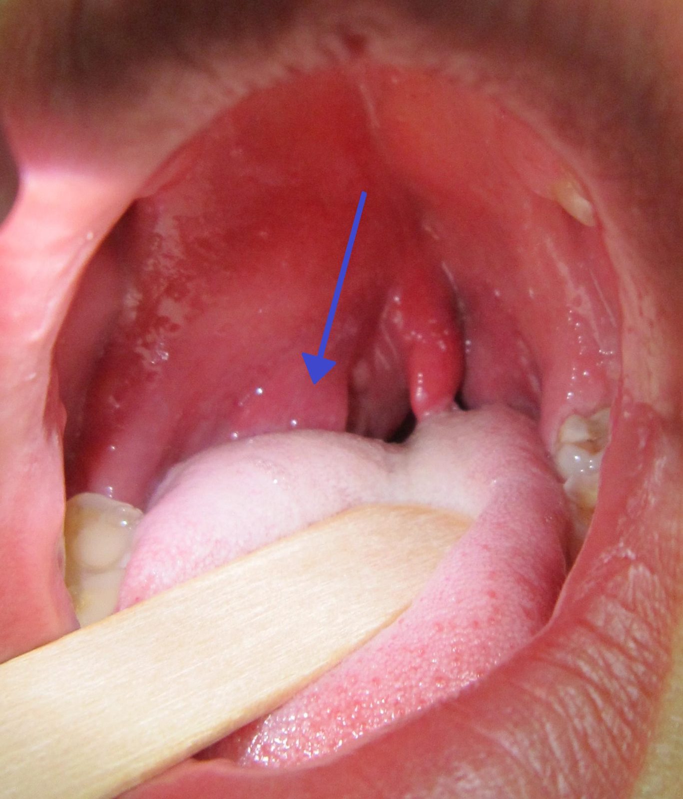Clinical photograph of asymmetric tonsillar swelling with contralateral uvular deviation typical of quinsy.