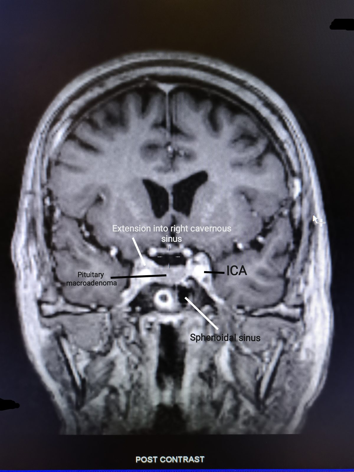 Coronal post-contrast MRI showing a pituitary macroadenoma expanding the sella and extending into the right cavernous sinus beside the internal carotid artery.