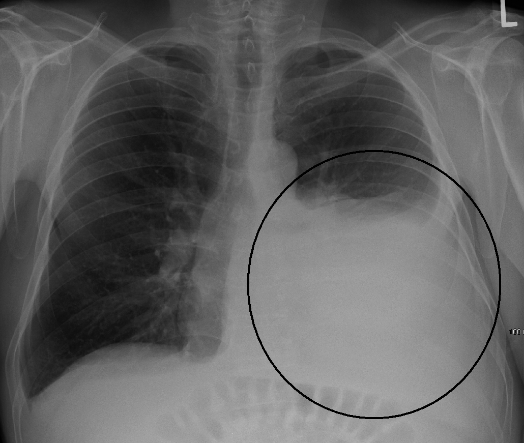 Chest radiograph with a dense basal opacity and meniscus sign at the affected costophrenic angle.