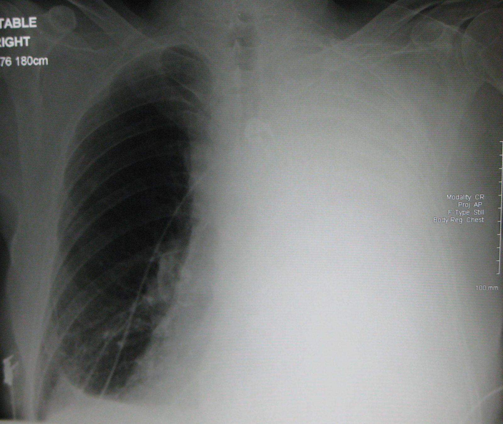 Thoracic ultrasound showing an anechoic pleural effusion above the diaphragm with adjacent lung, illustrating why ultrasound guides safe aspiration and drain placement.