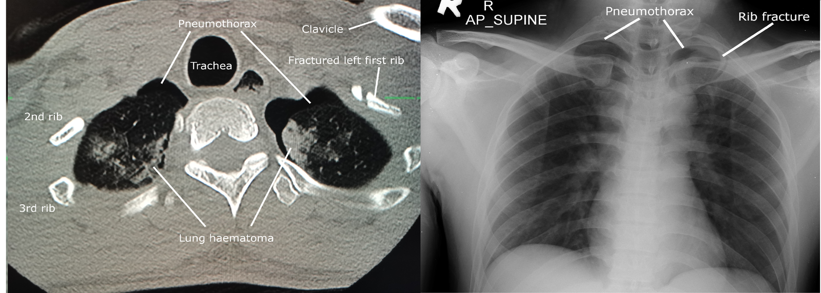 Chest radiograph with a visible pleural line and absent peripheral lung markings on the affected side, linked to the corresponding CT appearance.