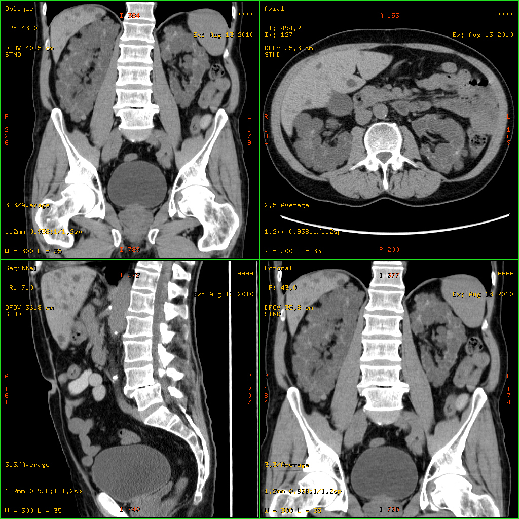 Multiplanar CT showing bilaterally enlarged kidneys containing numerous cysts of varying size in autosomal dominant polycystic kidney disease.