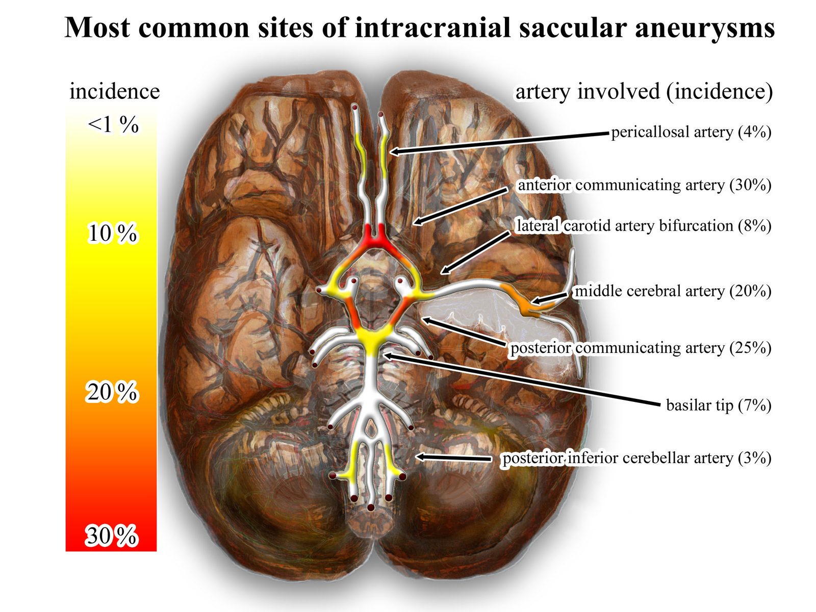 An illustration or angiogram of a berry aneurysm at a circle of Willis branch point, the feared extrarenal complication causing subarachnoid haemorrhage.