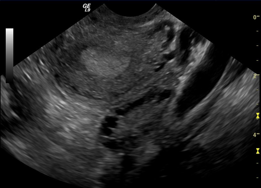 Ultrasound image showing multiple small antral follicles, labelled as follicular morphology rather than true ovarian cysts and accompanied by the reminder that morphology alone does not diagnose PCOS.