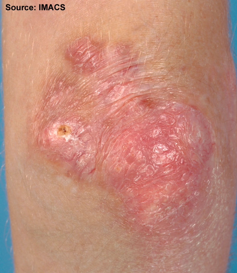 A clinical photograph showing violaceous scaly papules or plaques over the extensor knuckles, with skin tone and lighting that preserve the diagnostic finding. This image remains subject to the separate image-quality review.