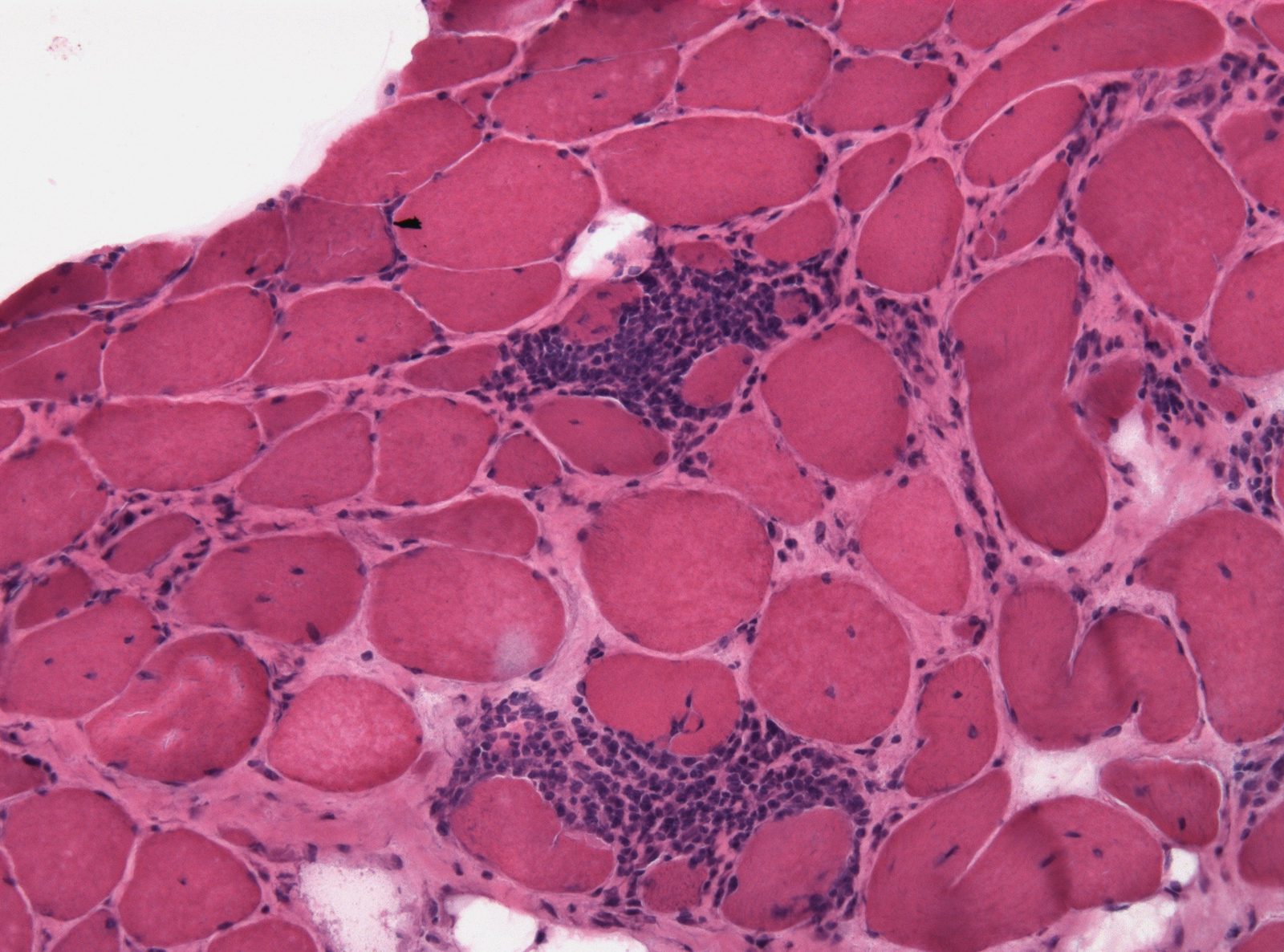 A muscle biopsy histology image showing an inflammatory myopathy pattern, with the limitation that biopsy appearances vary by subtype and should not be used as a single visual diagnostic rule.