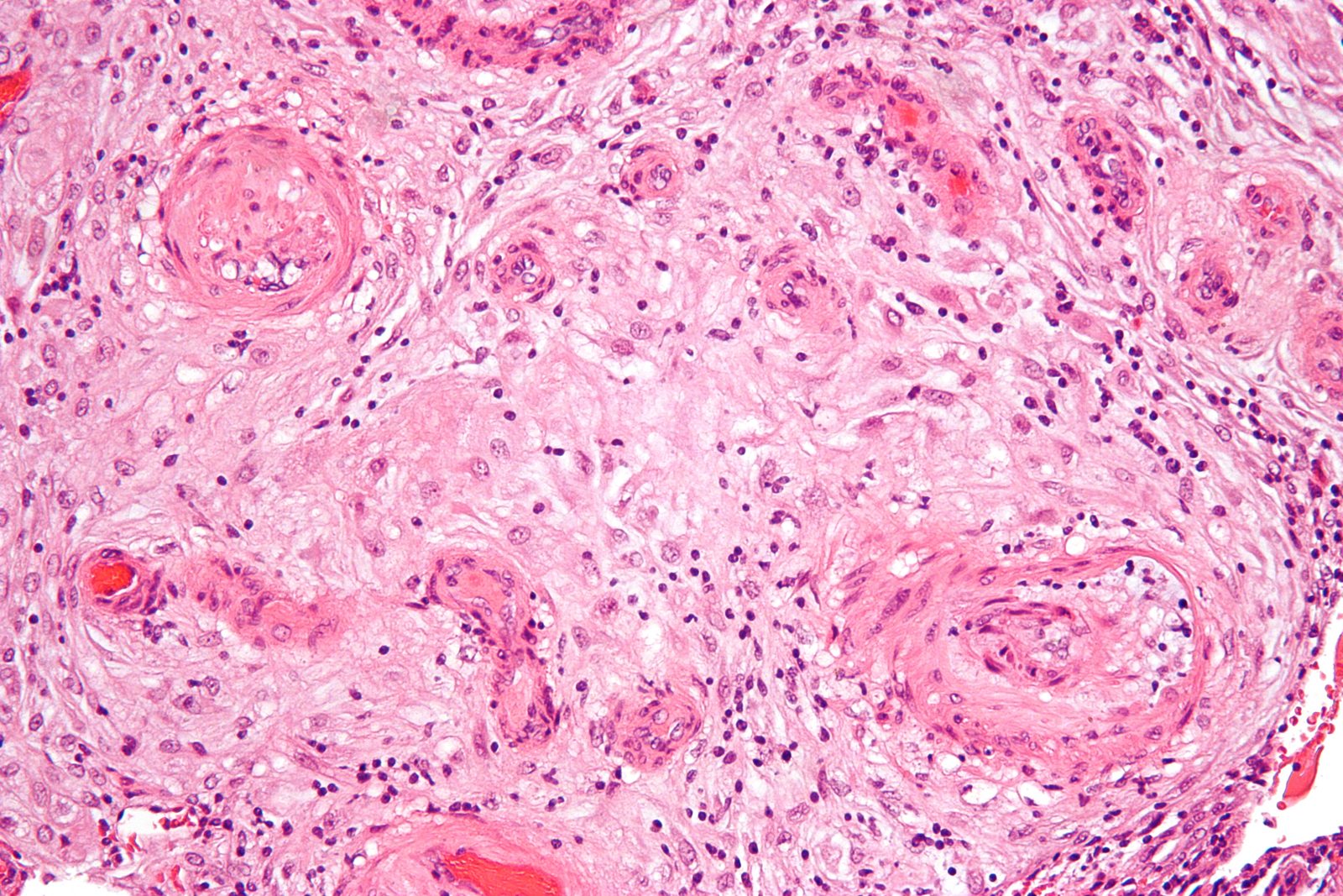 Histology showing decidual vasculopathy of uteroplacental vessels in pre-eclampsia; use alongside, not instead of, the current clinical diagnostic criteria.