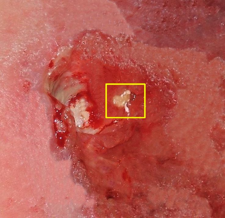 A clinical photograph of a deep stage 4 pressure ulcer over a bony prominence, with full-thickness tissue loss and exposed bone.