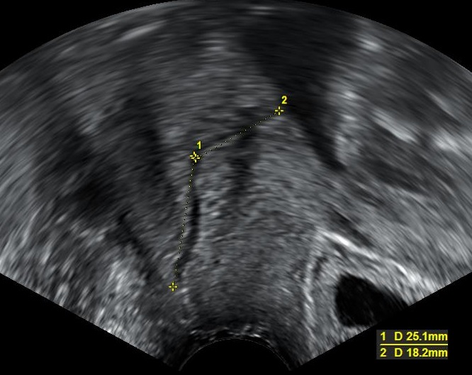 Transvaginal ultrasound with calipers demonstrating cervical-length measurement and a note that NICE uses 15 mm to assess likelihood of birth within 48 hours in symptomatic people at 30 weeks or more.