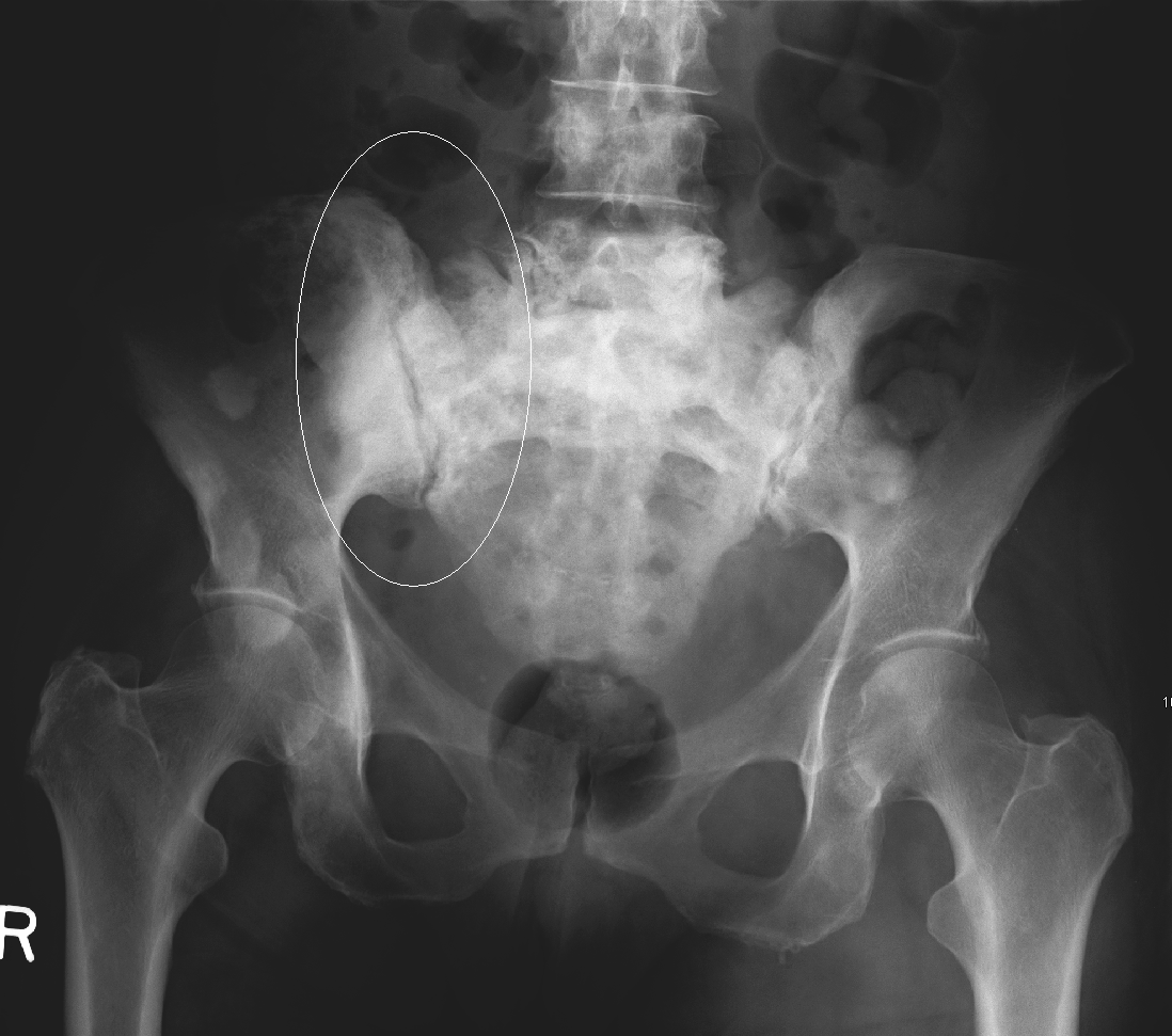 CT image showing sclerotic (osteoblastic) metastatic deposits in the pelvis and proximal femora, typical of prostate cancer.