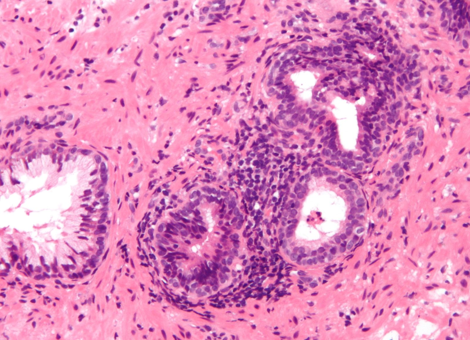H&E prostate histology showing a dense chronic inflammatory infiltrate surrounding prostatic glands, the pathological correlate of chronic prostatitis.