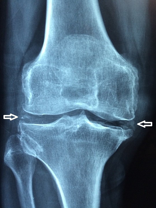Radiograph of the knee showing linear calcification of the meniscal and articular cartilage (chondrocalcinosis), a supportive feature of calcium pyrophosphate deposition.