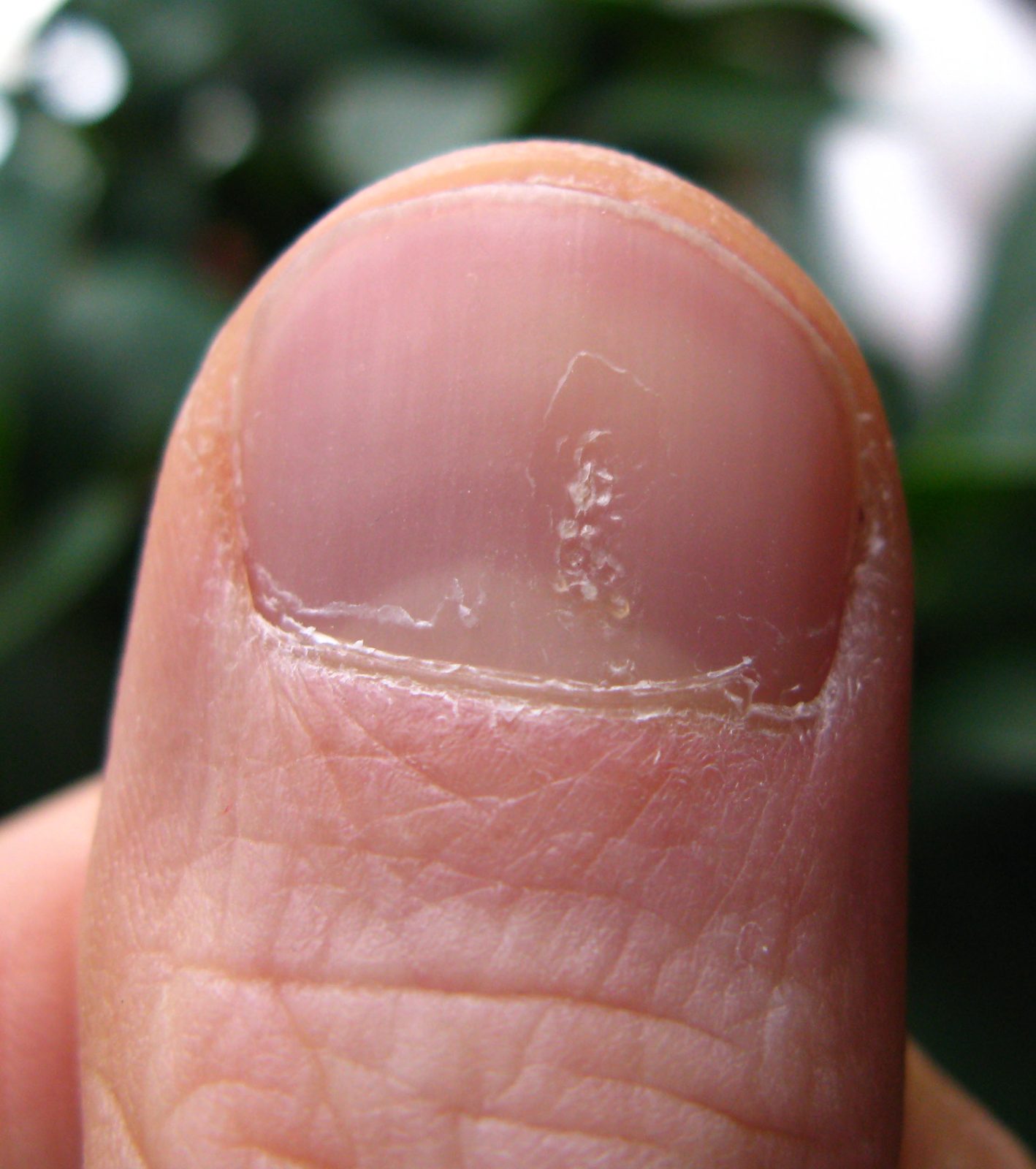 Close-up photograph of nail pitting and onycholysis associated with psoriasis and psoriatic arthritis.