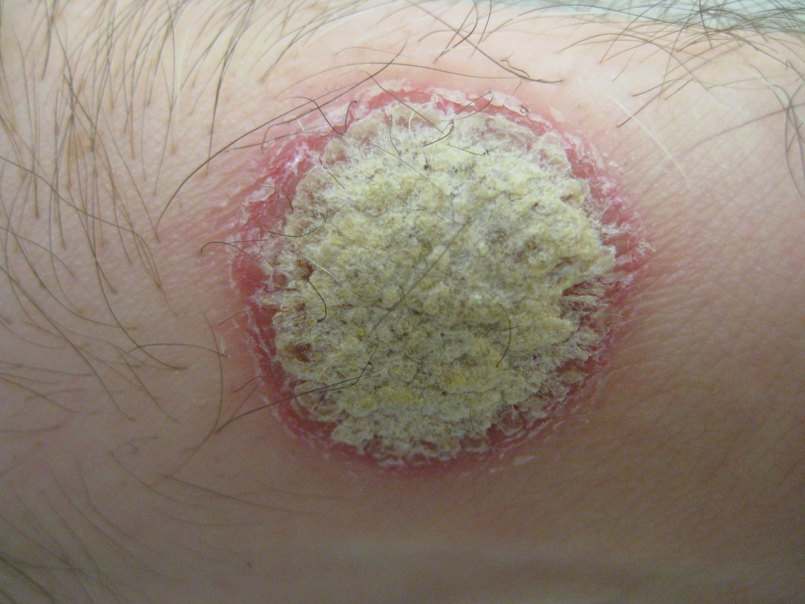 A sharply demarcated erythematous plaque surmounted by adherent silvery-white scale, characteristic of chronic plaque psoriasis.
