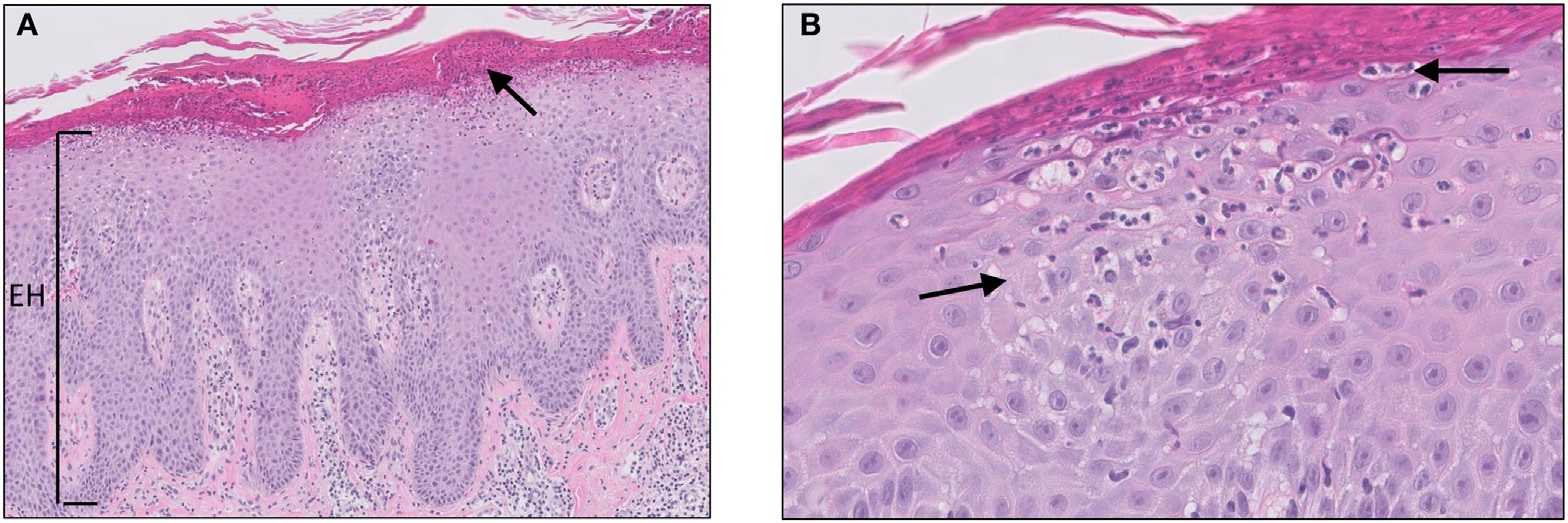 Micrograph of psoriasis showing epidermal hyperproliferation with parakeratosis, elongated rete ridges, dilated dermal capillaries and an immune infiltrate.