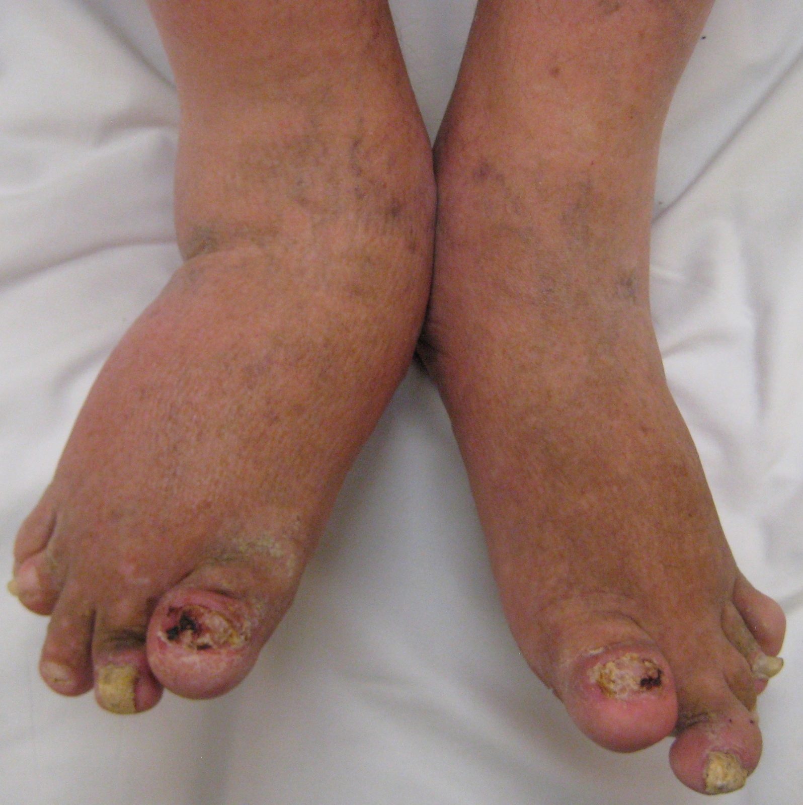 Clinical photograph showing distal joint deformity and nail dystrophy in psoriatic arthritis.