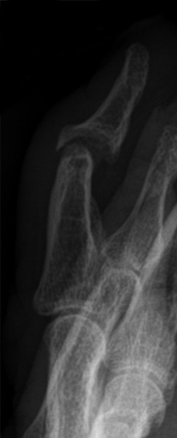 Radiograph showing the pencil-in-cup deformity of severe erosive psoriatic arthritis.