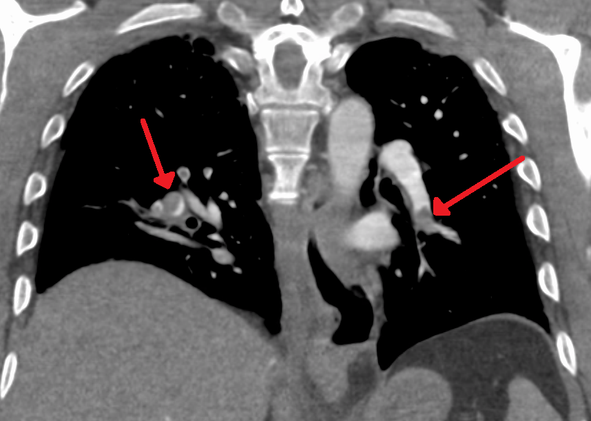 Axial CTPA image showing a dark filling defect within a contrast-opacified pulmonary artery.