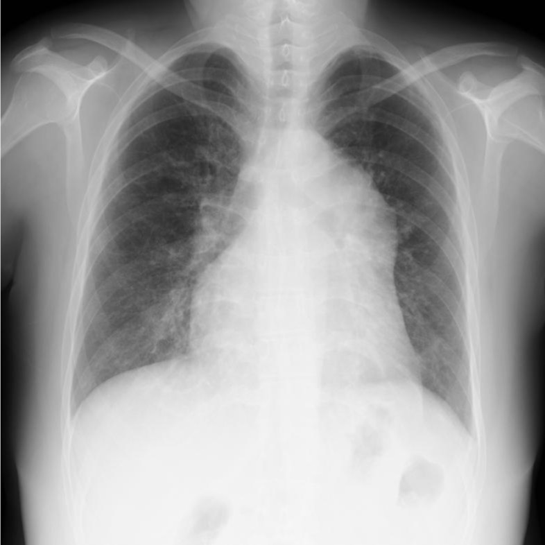 A chest radiograph showing cardiomegaly and prominent central pulmonary arterial contours in advanced pulmonary hypertension, with a legend warning that radiography supports but cannot confirm the diagnosis.