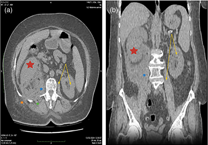 Axial and coronal CT showing a destroyed pyonephrotic right kidney with perirenal phlegmon extending into the psoas and posterior abdominal wall.