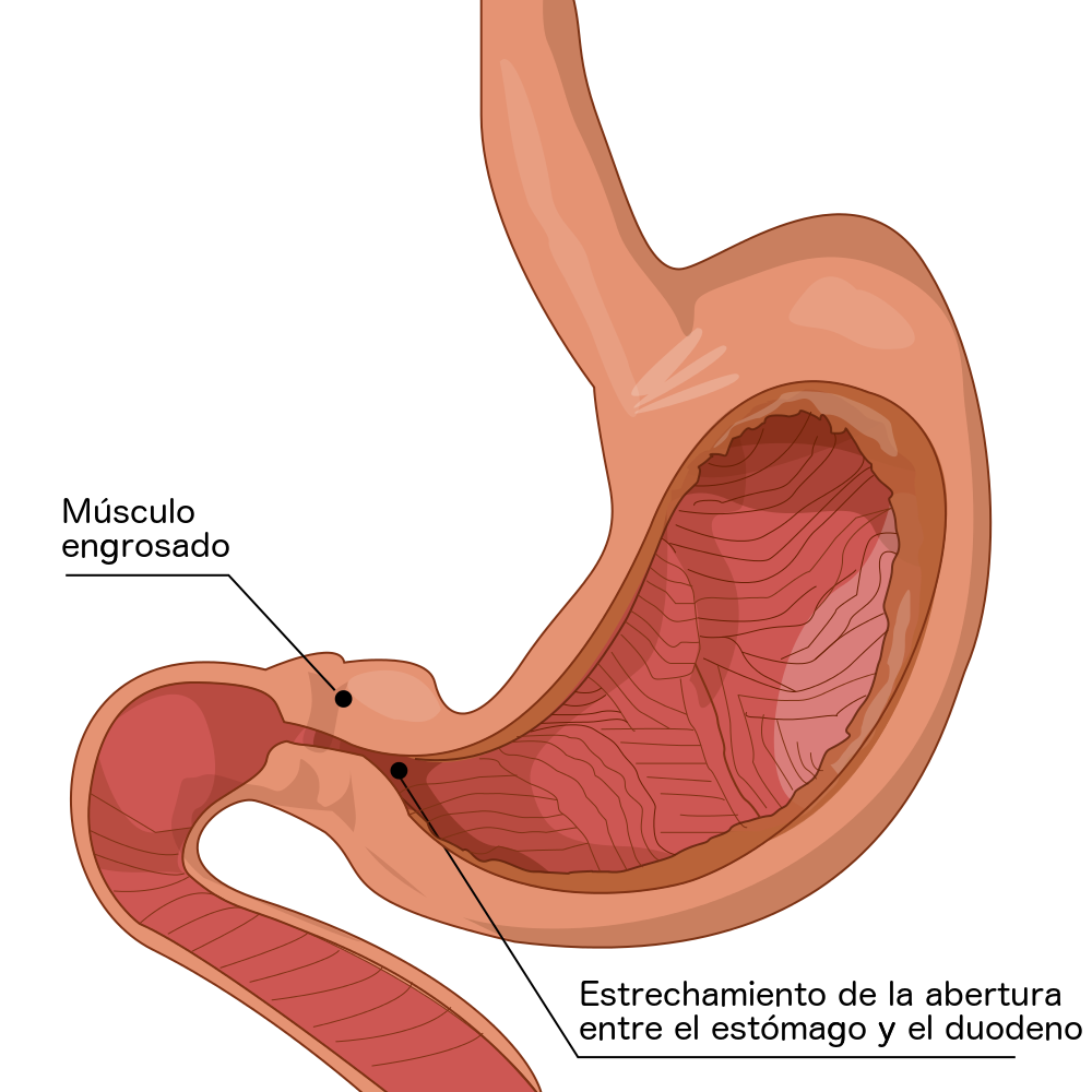 Ultrasound image demonstrating the thickened pyloric muscle used to support diagnosis; label the need for local paediatric radiology criteria.