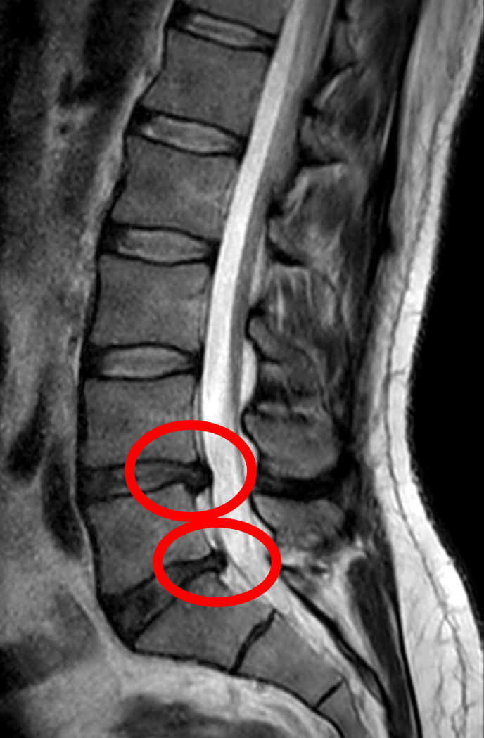 Sagittal lumbar MRI showing lower-lumbar disc protrusions indenting the ventral thecal sac, with an educational annotation that radiological abnormalities are common and need clinical correlation.