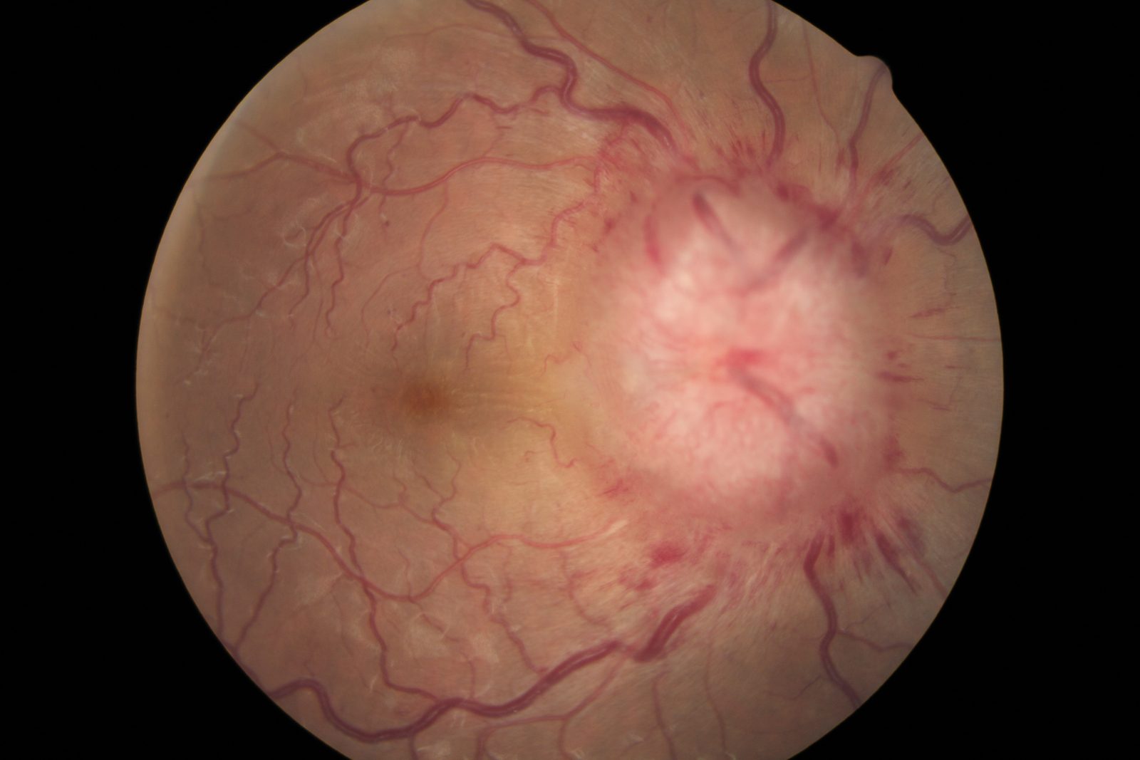 A fundoscopic image of a swollen optic disc with blurred margins, with a note that papilloedema indicates sustained optic-nerve sheath pressure but may be absent in acute raised intracranial pressure.