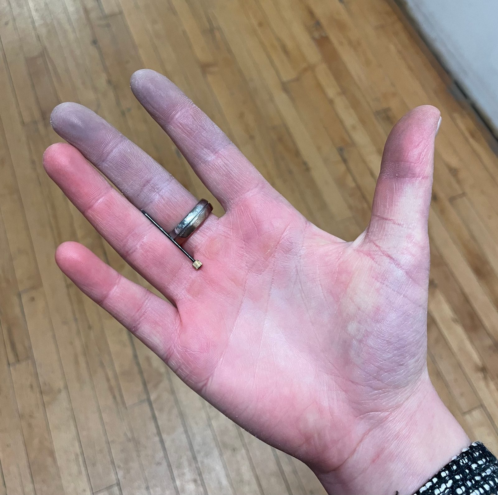 A clinical photograph showing sharply demarcated pallor and blue-purple cyanosis affecting several fingers during an attack. The image must preserve the colour contrast and not imply that every attack is triphasic.