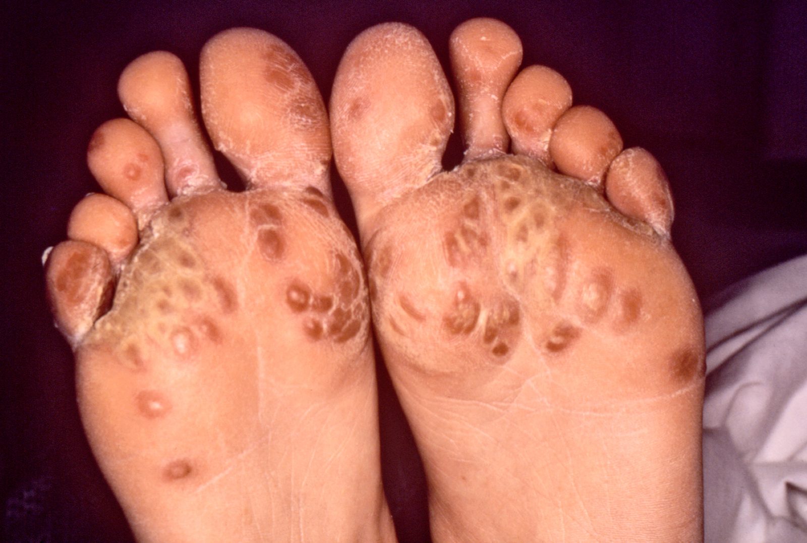 Clinical photograph showing hyperkeratotic plaques on the soles, a possible skin manifestation of reactive arthritis.